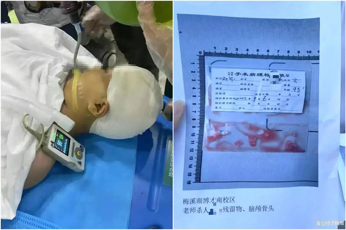 Photos provided by the girl’s mother showed that skull fragments and foreign material were removed from her brain.