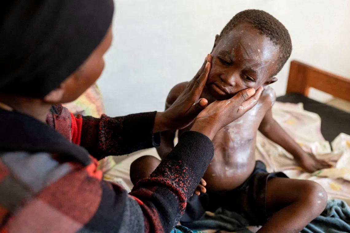 FILE PHOTO: Furaha Elisabeth applies medication on the skin of her child Sagesse Hakizimana who is under treatment against Mpox, an infectious disease caused by the Mpox virus that causes a painful rash, enlarged lymph nodes and fever, at a health centre in Munigi, Nyiragongo territory, near Goma in North Kivu province of the Democratic Republic of Congo August 19, 2024. REUTERS/Arlette Bashizi/File Photo