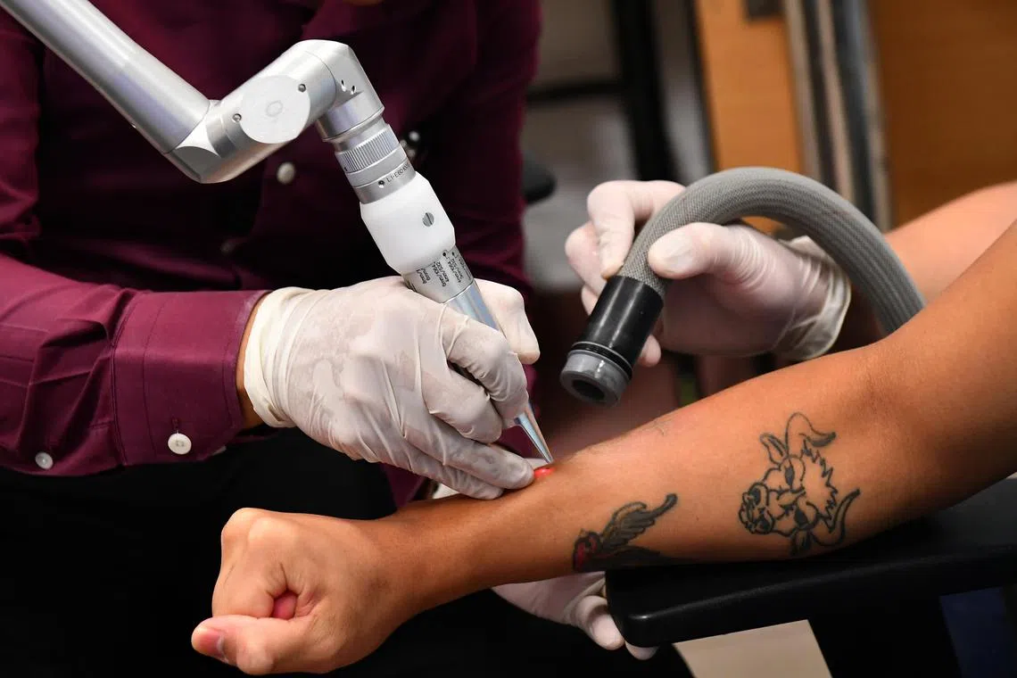 File photo of a person undergoing tattoo removal.