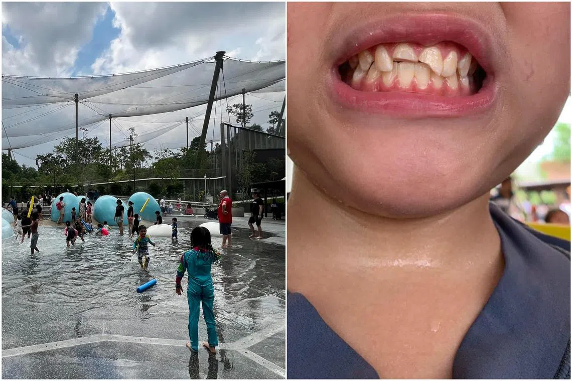 An 11-year-old boy broke two of his front teeth during an accident at the Egg Splash playground at Bird Paradise on May 20.