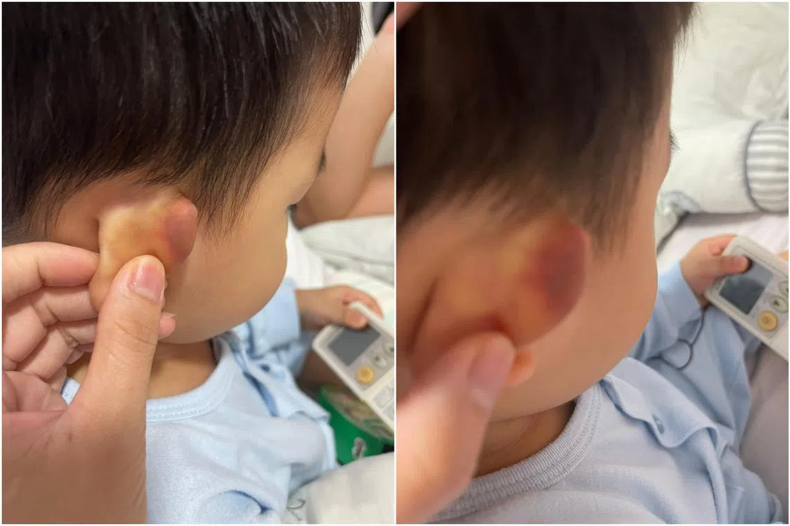 Operations executive Toh Kian Boon discovered a bruise the size of a 50-cent coin on his 22-month-old son's ear after the child's fourth day at school.