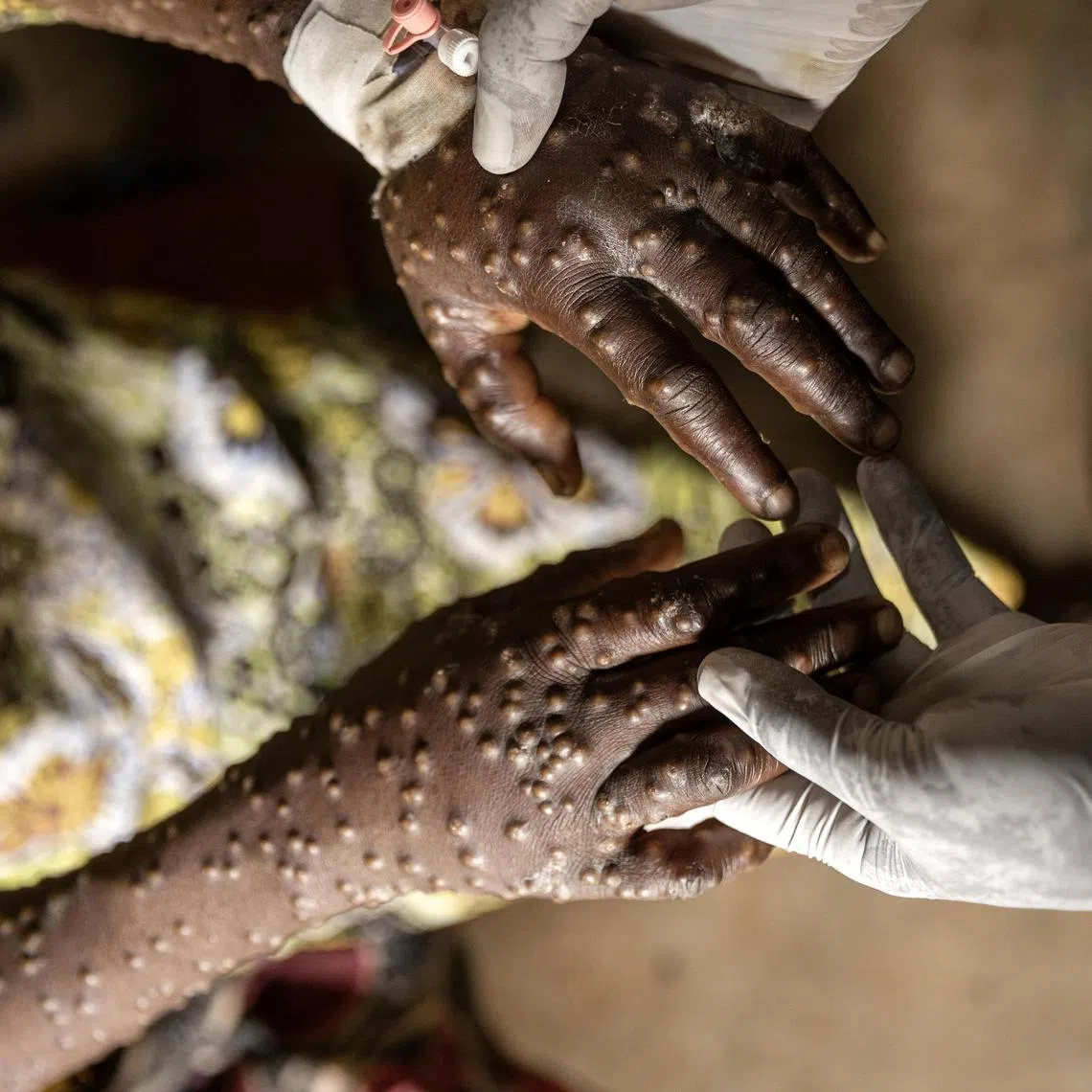 An mpox patient is treated at the Kavumu hospital in Karanrhada, Kamavu, South Kivu province, Democratic Republic of Congo, in September 2024.