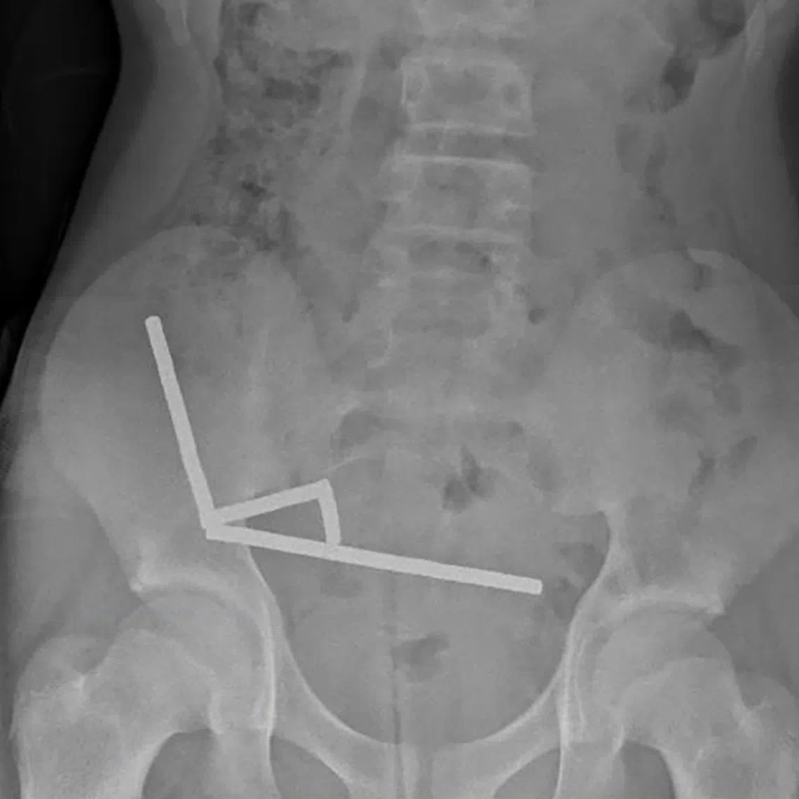 An x-ray image of pieces of high-power magnets clumped up in the intenstines of a New Zealand teenager in Tauranga.