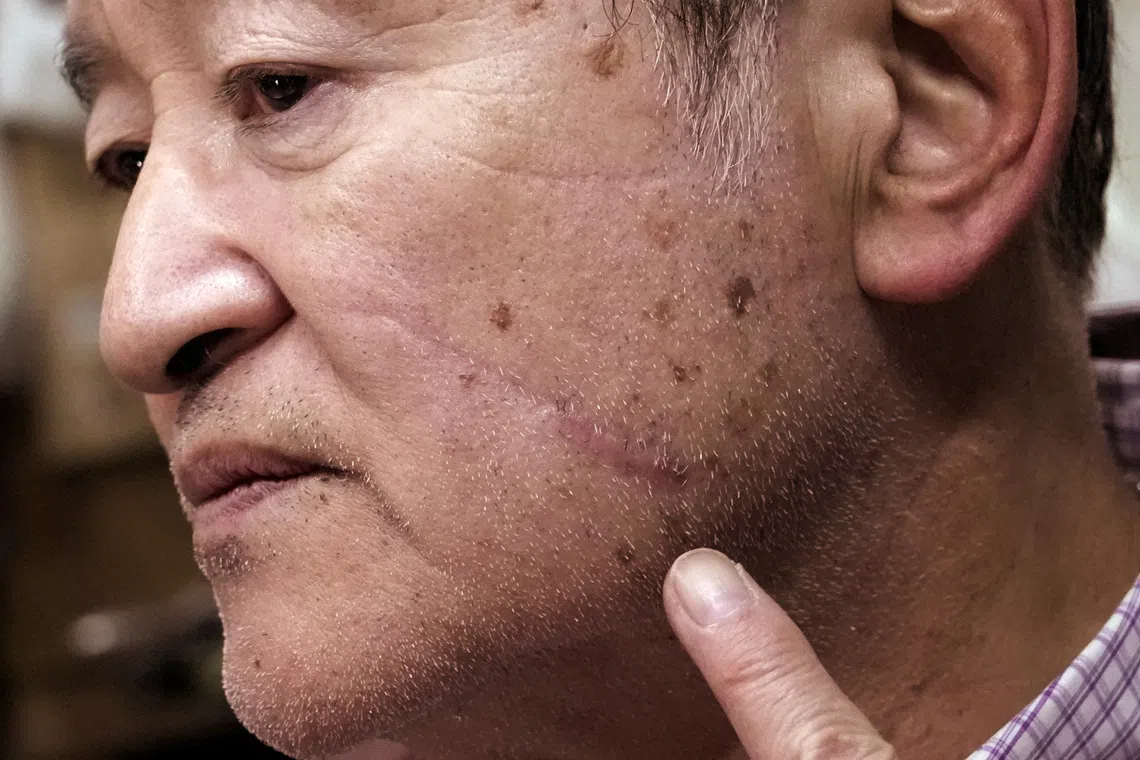 Mr Keiji Minatoya, 68, a confectionery shop owner who was attacked by a black bear in 2023, points to a scar on his face from the attack. 