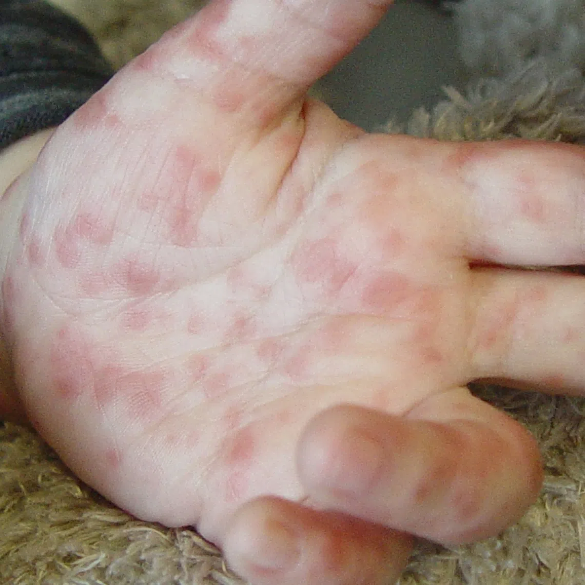 As the rainy season begins, increased humidity creates ideal conditions for the spread of communicable diseases like hand, foot, and mouth disease (HFMD).