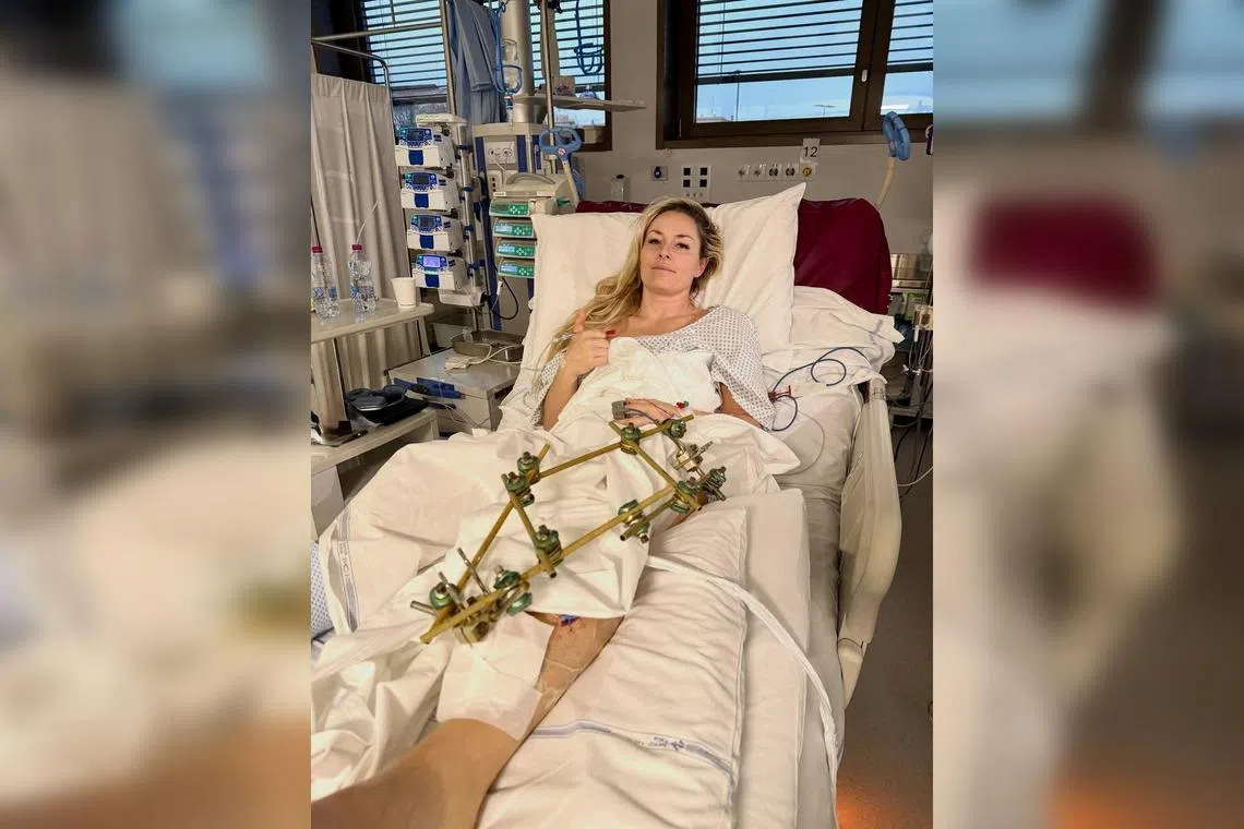 Lindsey Vonn suffered multiple fractures in her left leg after a high-speed fall during the Olympic downhill in Cortina on Feb 8.