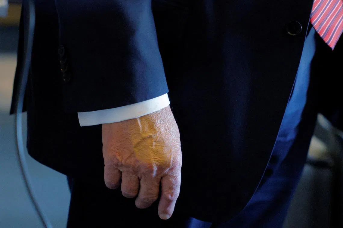 FILE PHOTO: Make-up covers the back of the right hand of U.S. President Donald Trump while he speaks to the press on board Air Force One en route to Doha, Qatar, May 14, 2025.  In a July 17, 2025 press briefing, U.S. Press Secretary Karoline Leavitt read a statement from his doctor that President Trump has a chronic venous insufficiency.  REUTERS/Brian Snyder/File Photo
