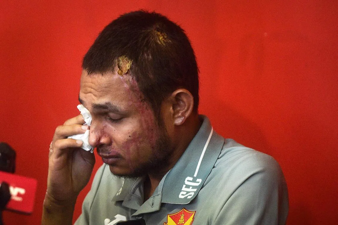 Malaysian national team and Selangor FC footballer Faisal Halim, who was severely injured in an acid attack, reacts during a press conference in Shah Alam in Selangor state on June 13, 2024. Halim, who suffered fourth-degree burns in an acid attack at a shopping mall outside Kuala Lumpur in May, said on June 13 he hopes to return to football in one or two months. (Photo by Arif Kartono / AFP)