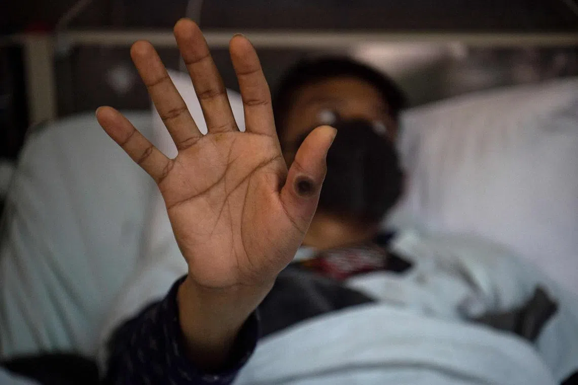This file photo taken on Aug 16, 2022, shows a patient showing his hand with a sore caused by an infection of the mpox virus in Lima, Peru.