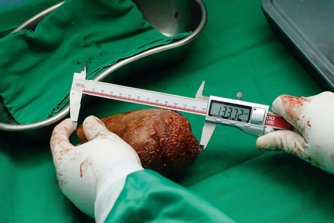 A military medical officer measuring a kidney stone removed from a retired soldier that weighed 801g and measured 13.37cm. 