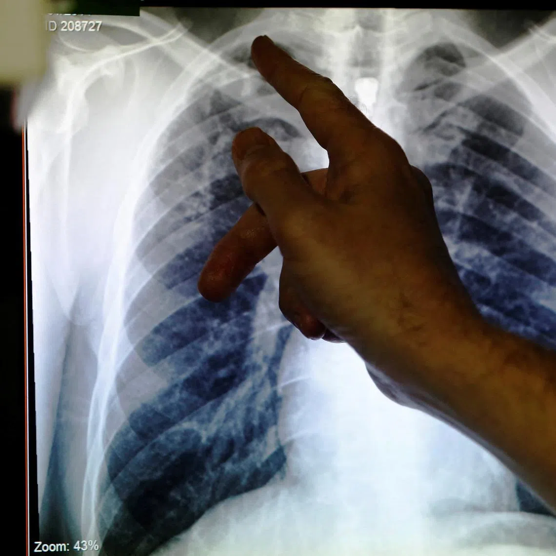 A pair of lungs infected with tuberculosis (TB). TB is endemic in Singapore.