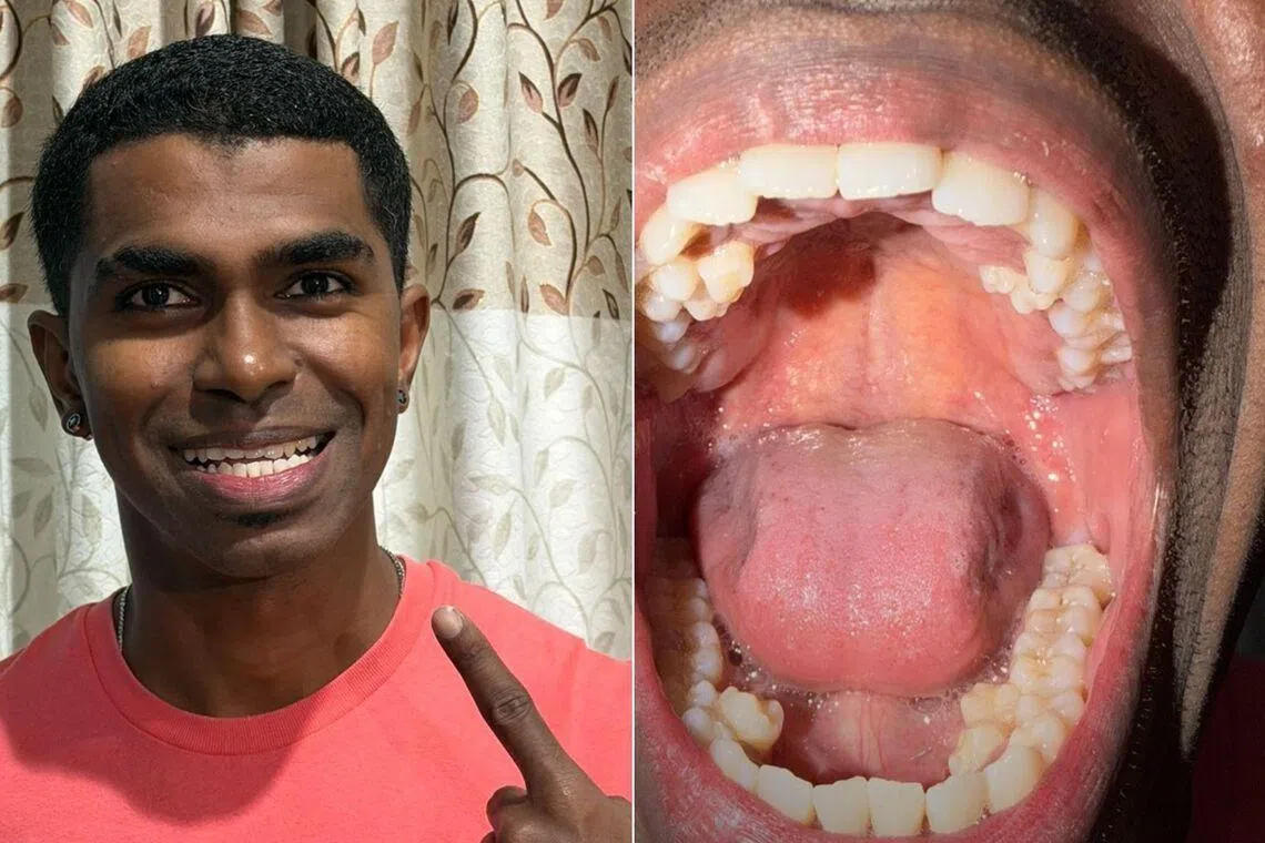 Engineer Prathab Muniandy said he first noticed that he had more teeth than average during a family gathering 2021.
