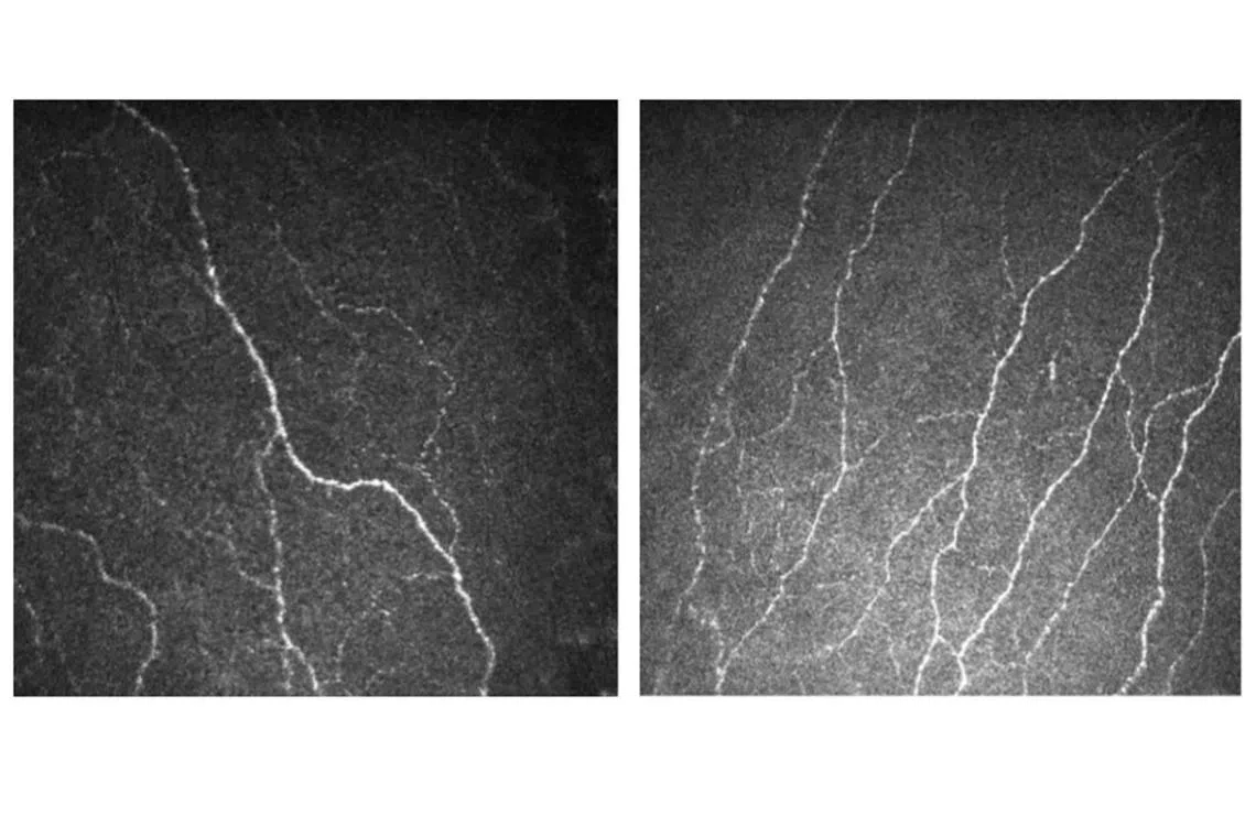 A patient's corneal nerves that were damaged due to diabetes (left) became healthier and increased in number with Fenofibrate, a lipid-lowering drug.