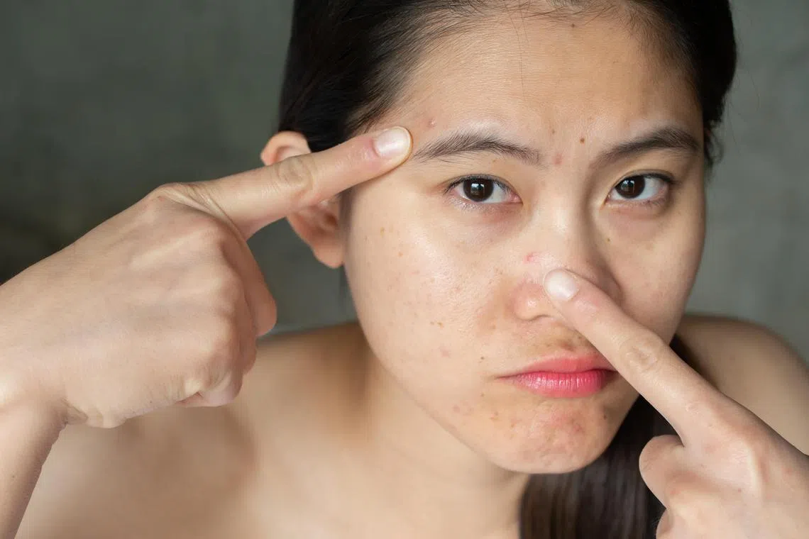 llacne - Istockphoto - Conceptual of problems on woman skin.