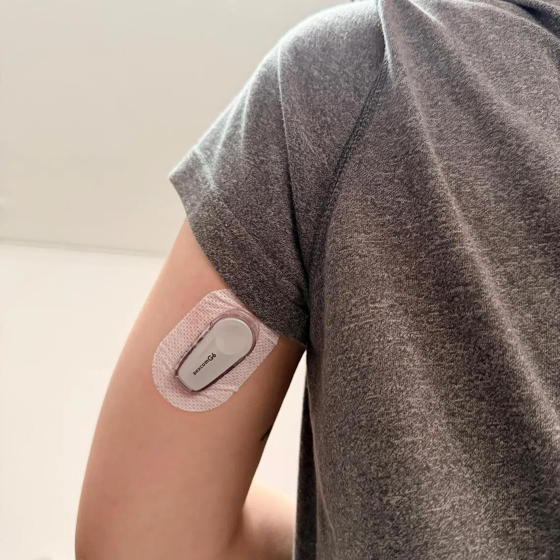Ms Ng Zhuang Shu, who has monogenic diabetes, uses the Dexcom G6 continuous glucose monitoring (CGM) system to monitor her blood sugar levels. This system currently is the only CGM device eligible for government subsidies.