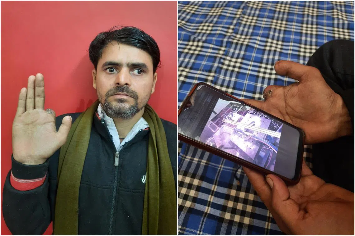 Mr Devinder Sharma lost his right index finger and a portion of his thumb while working with a power press in Faridabad in northern India on Sept 9.