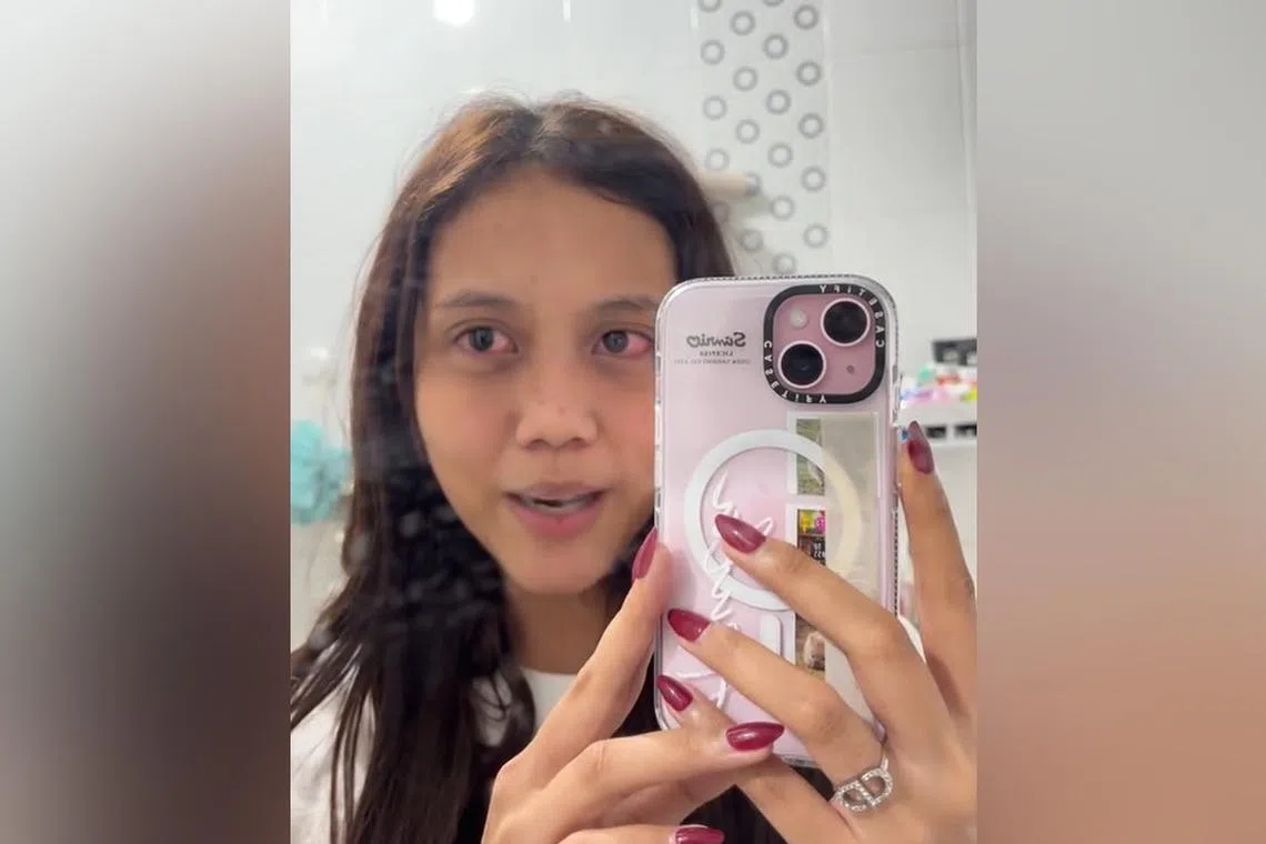 Ms Azula said she started feeling a stinging sensation in both eyes after a few hours of wearing them.