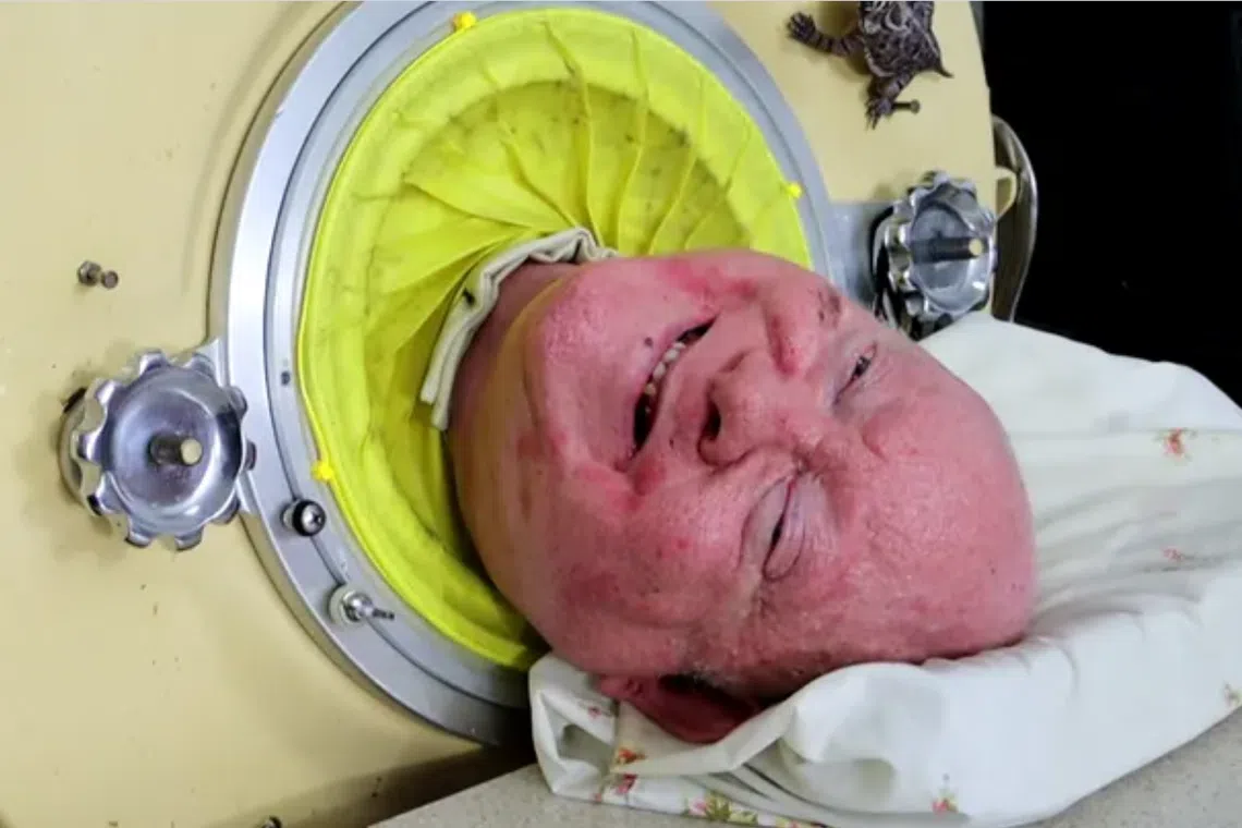 Mr Paul Alexander lived inside an iron lung after contracting polio in 1952. 