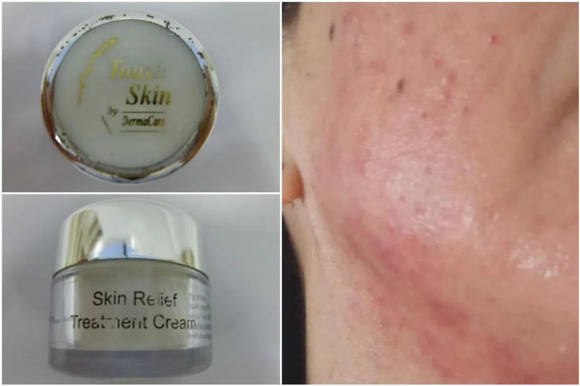 A woman suffered severe skin reactions after using Touch Skin by DermaCare Skin Relief Treatment Cream.