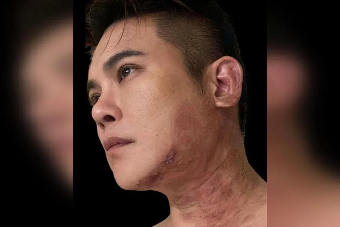Actor Nick Shen said he developed symptoms as early as July, and that the pain was beyond description.