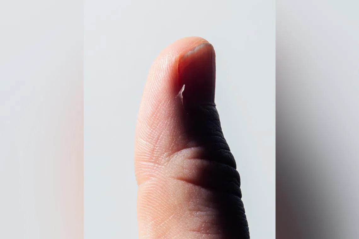Hangnails usually go away on their own, but experts say there are ways to speed up the healing process.