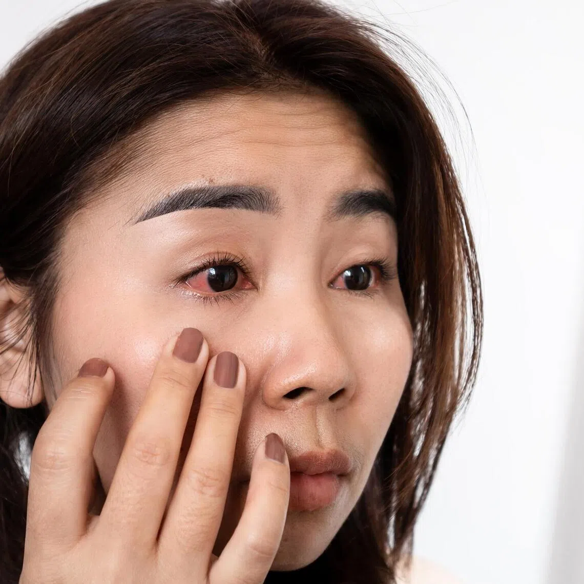 Seek medical help for recurring red eyes, rather than relying on over-the-counter eyedrops.
