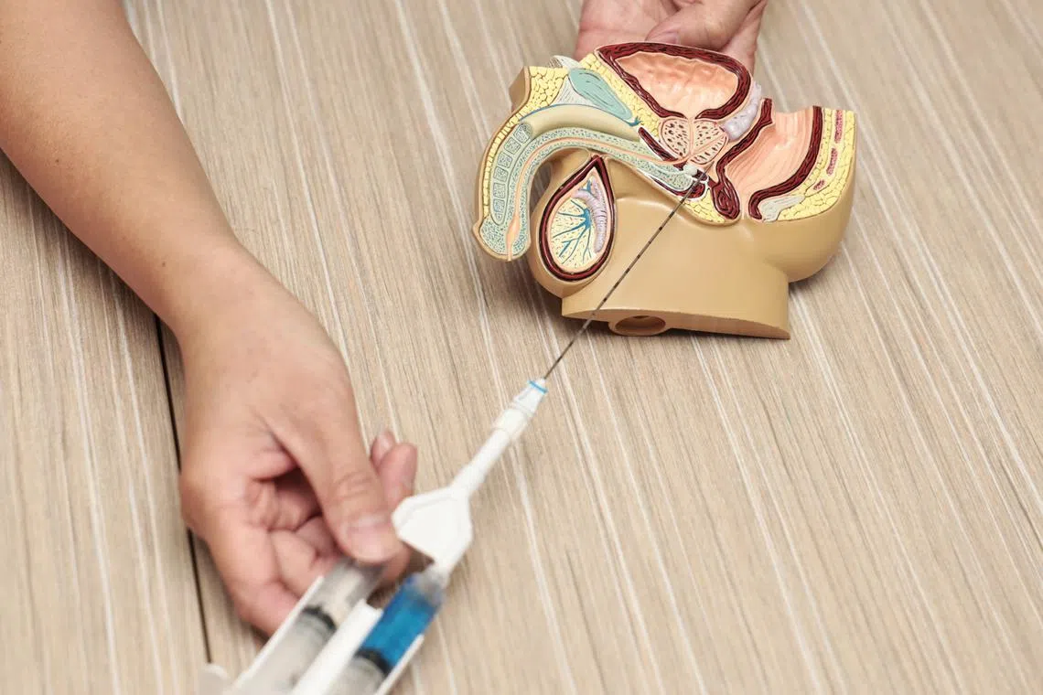 Rectal spacers work by acting as a physical barrier between the prostate and the rectum, reducing the radiation dose to the rectum and decreasing the risk of side effects.