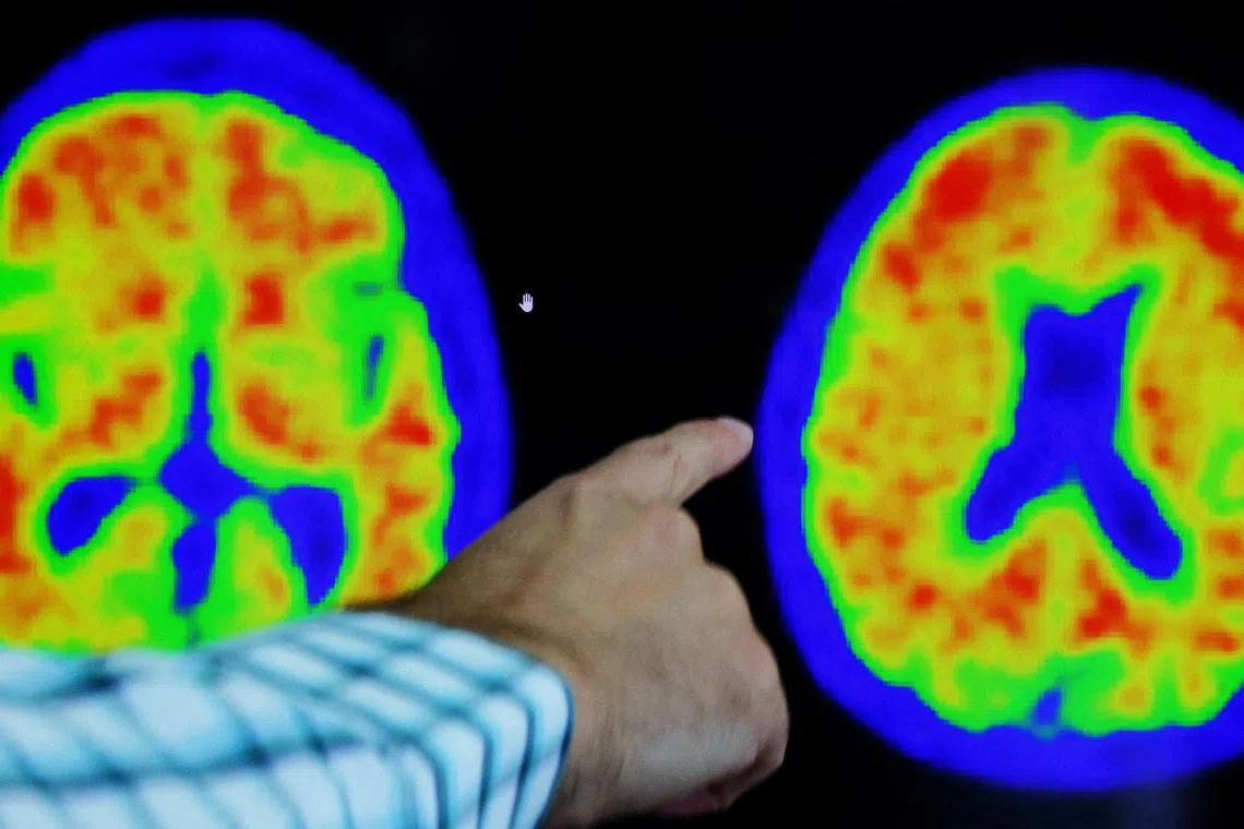 FILE PHOTO: A doctor points out evidence of Alzheimer’s disease on PET scans at the Center for Alzheimer Research and Treatment (CART) at Brigham And Women’s Hospital in Boston, Massachusetts, U.S., March 30, 2023.  REUTERS/Brian Snyder/File Photo
