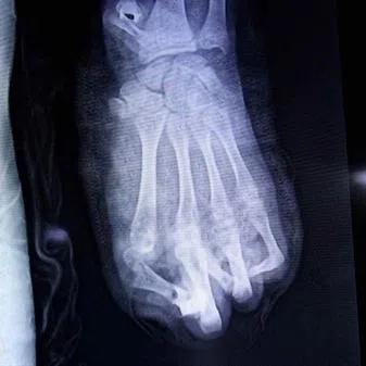 A 15-year-old boy in Vietnam suffered near-total loss of his lefthand after an injury caused by an explosive firework.