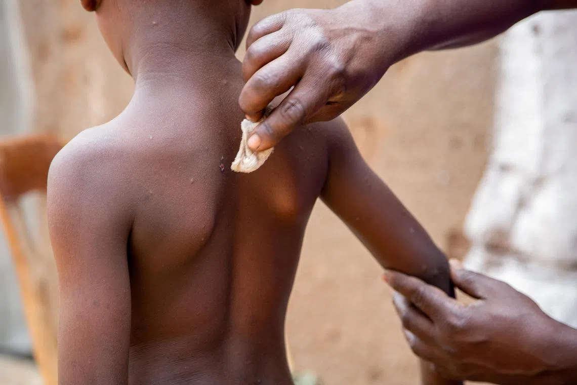In August, the WHO declared mpox a global public health emergency, following an outbreak of the viral infection in the Democratic Republic of Congo that spread to neighbouring countries.