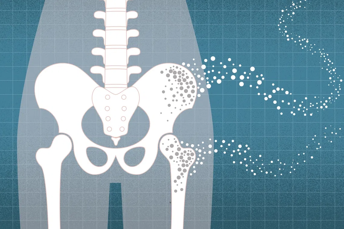 Osteoporosis is a silent disease. In the early stages, it often has no symptoms and may go undetected until a fracture occurs.