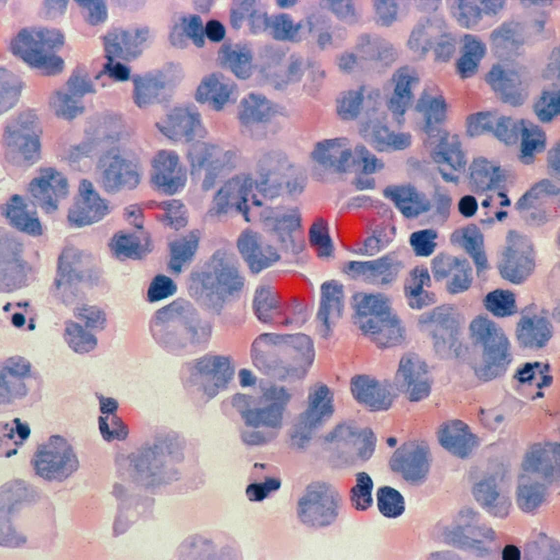 An estimated 16 per cent of expected cancer diagnoses across Australia, Canada, Denmark, Ireland, New Zealand, Norway and Britain were missing between April and December 2020.