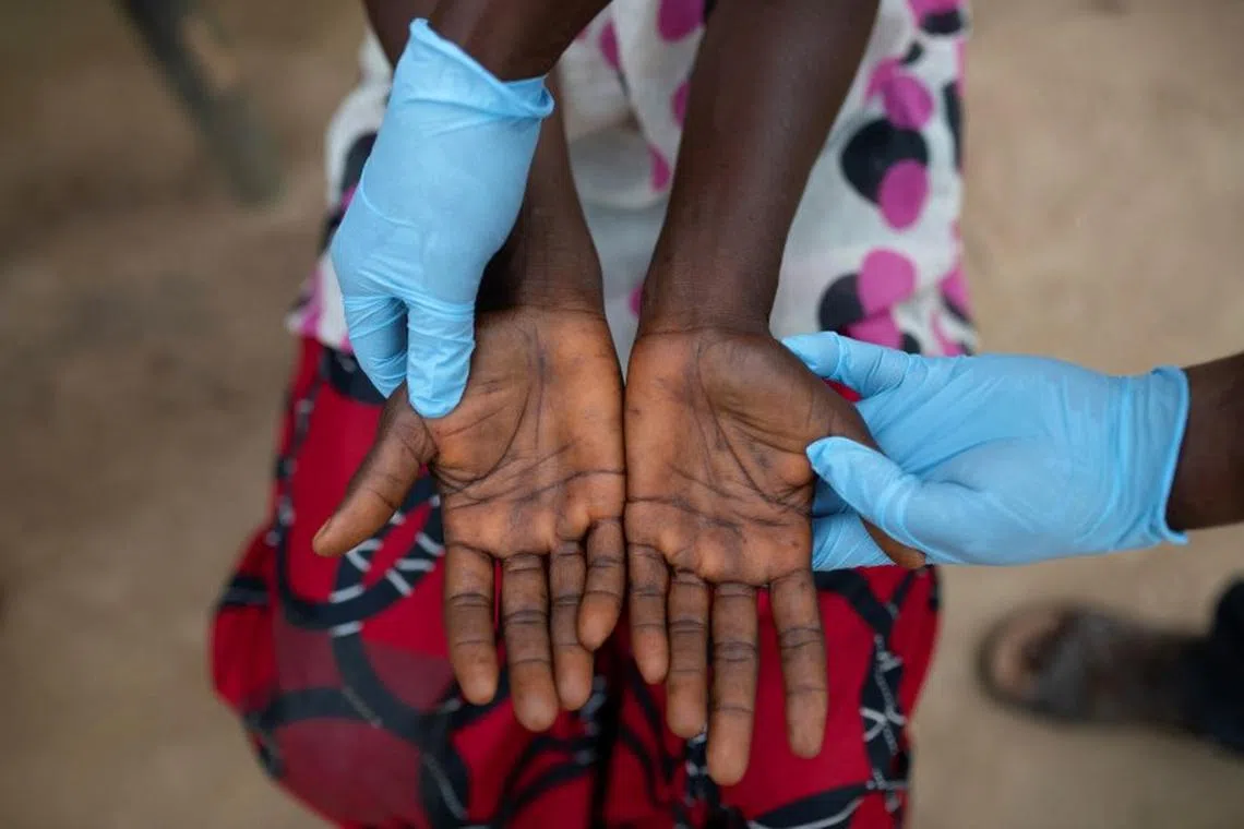 FILE PHOTO: Alingo Likaka Manasse, head nurse at the Yalanga Health Centre, examines lesions on the hands of Lituka Wenda Dety, 41, who is suffering from monkeypox, in Yakusu, Tshopo, Democratic Republic of the Congo, October 2, 2022. REUTERS/Arlette Bashizi/File Photo