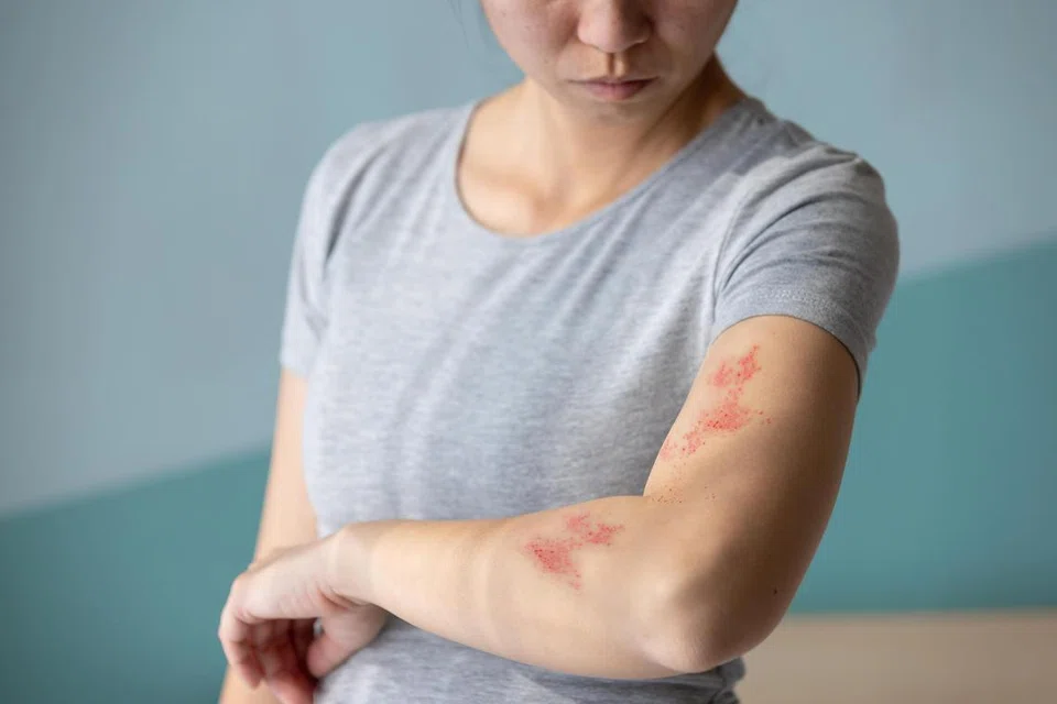 askST: What is shingles and how do you prevent it? | The Straits Times