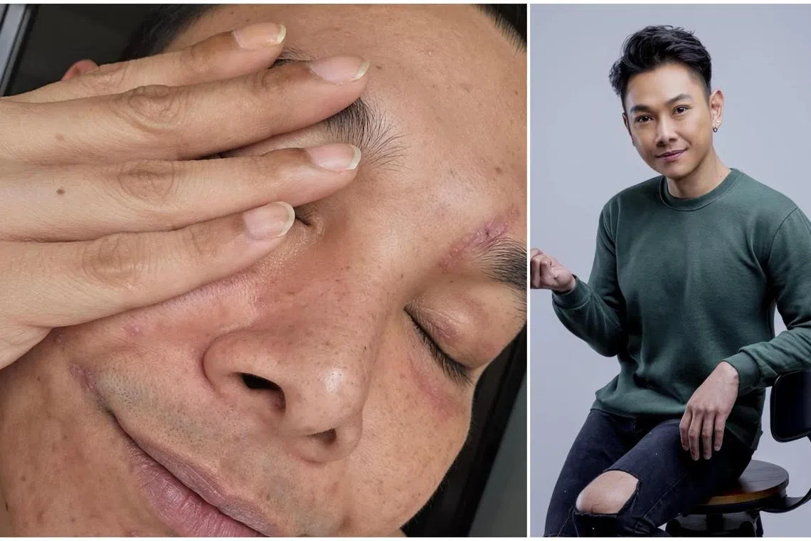 Actor Ryan Lian shared close-ups of his three scars: one by the side of his lip, one on his chin and another around his left eyebrow. 