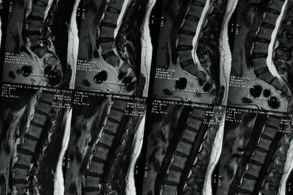 In Singapore, a school-based scoliosis screening programme screens tweens and teenagers yearly.