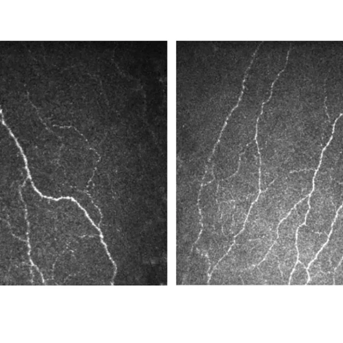 A patient's corneal nerves that were damaged due to diabetes (left) became healthier and increased in number with Fenofibrate, a lipid-lowering drug.