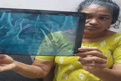 வயிற்றில் கத்திரிக்கோல் இருக்கும் ஊடுகதிர்ப் படத்துடன் உ‌‌‌ஷா.