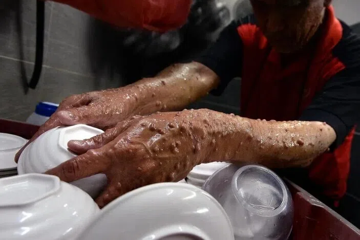 அரியவகை உடற்குறைபாட்டுக்கு ஆளானோர் ஒன்றுகூடி ஆதரவு