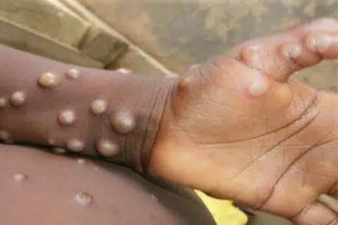 எம்பாக்ஸ் கிருமியால் ஏற்படும் பாதிப்பு.