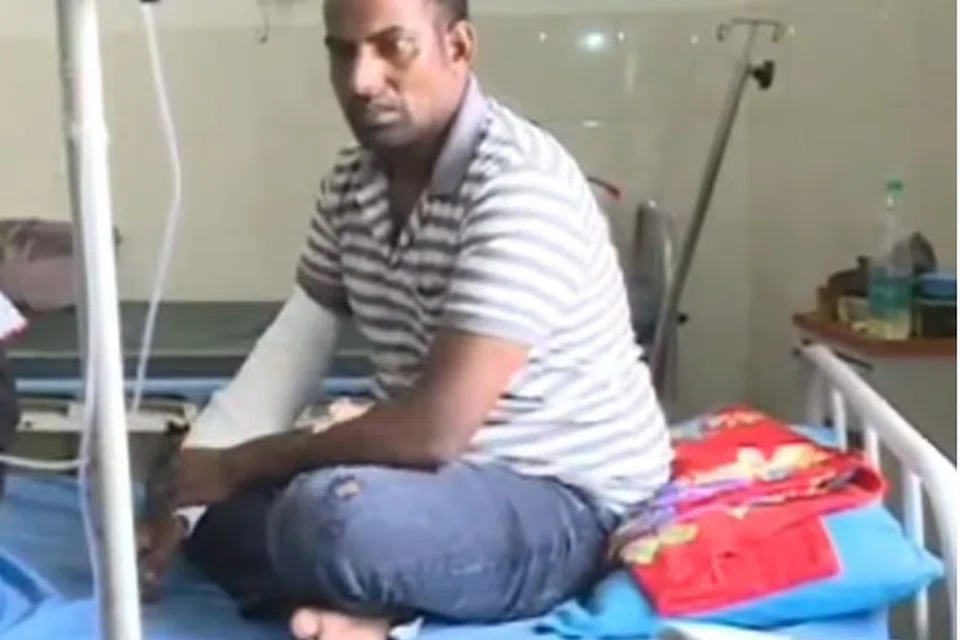 அமில (ஆசிட்) வீச்சால் பாதிக்கப்பட்ட ஜூபேர் அகமத்.