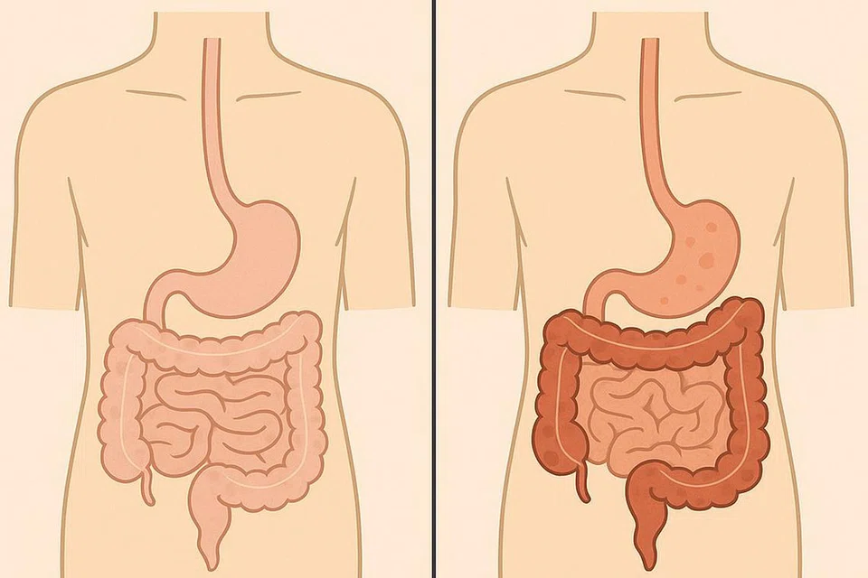 நலமான வயிறும் குடலும் (இடது), குடல் அழற்சி நோயால் ஏற்பட்டுள்ள வீக்கம்.