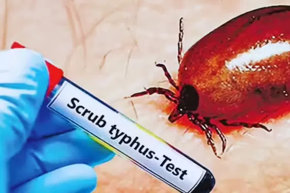 ஆந்திராவில் 1,592 பேருக்கு ஸ்க்ரப் டைபஸ் (உண்ணிக் காய்ச்சல்) தொற்று; தமிழகத்திலும் பரவல் அபாயம்