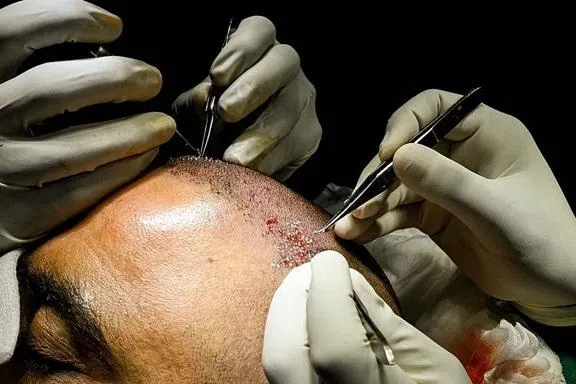 சிகை மாற்று சிகிச்சை மையங்களுக்கு சுகாதாரத் துறை கட்டுப்பாடு