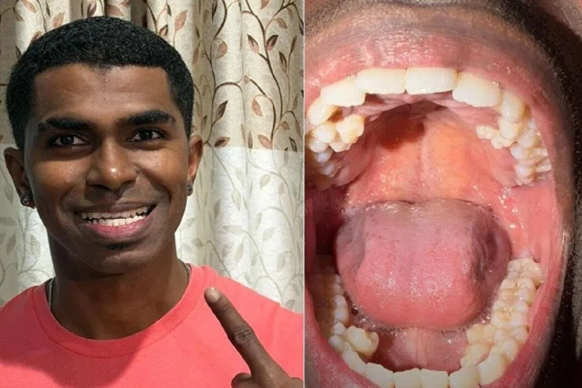 42 பற்களுடன் உலக சாதனை படைத்த பிரதாப் முனியாண்டி