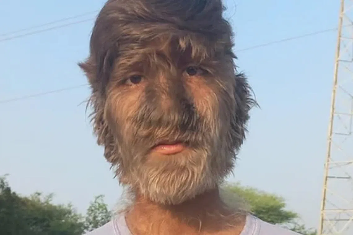 இப்படியும் ஒரு சாதனை: முகம் முழுவதும் முடி