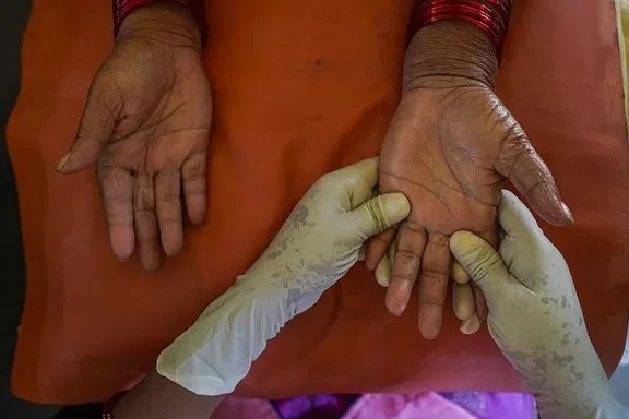 சிறார்கள் இடையே தொழுநோய் பாதிப்பு அதிகரிப்பு: சுகாதாரத்துறை ஆய்வில் உறுதி