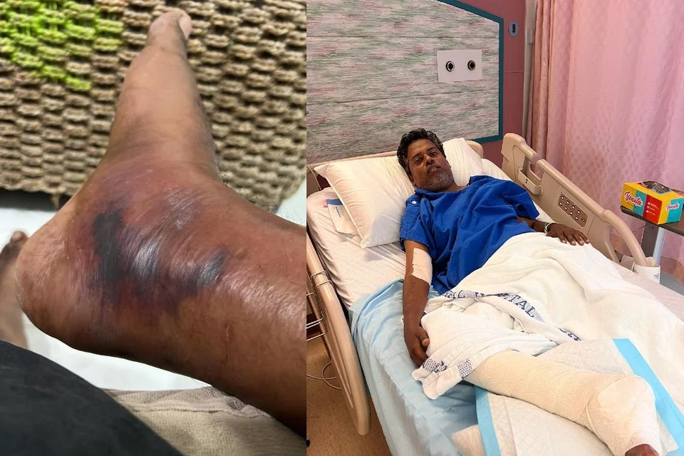 சதை உண்ணும் பாக்டீரியாவினால் காலையே கிட்டத்தட்ட இழந்த வெளிநாட்டு ஊழியர் திரு அம்ஜத் கான், 42, சிங்கப்பூரர்களின் நிதியுதவியோடு சிகிச்சைகள் மேற்கொண்டு குணமடைந்துவருகிறார். 