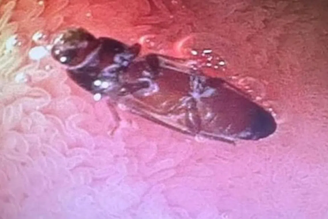 டெல்லி இளையரின் குடலில் குடியிருந்த கரப்பான்பூச்சி, இந்தியா செய்திகள் ...