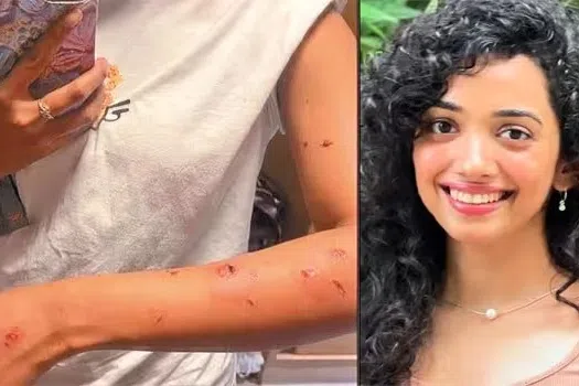 படப்பிடிப்பில் கொதிக்கும் எண்ணெய் கொட்டி சான்வி மேக்னா காயம்